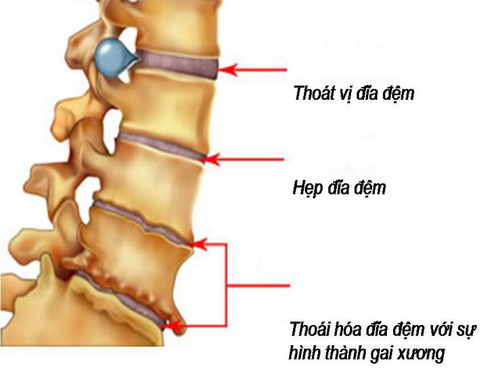 Nhận biết một số bệnh cột sống thường gặp